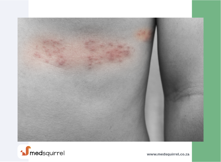 Slideshow Shingles Symptoms Causes And Treatments Are Shingles Contagious Rash On Face Shingling