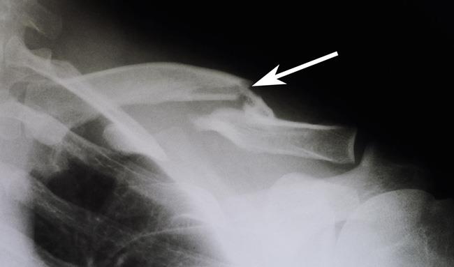 Clavicle Fracture